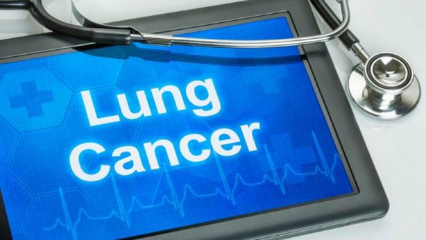 lung cancer- smoking